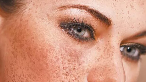 5 Ways to Better Cope With Melasma