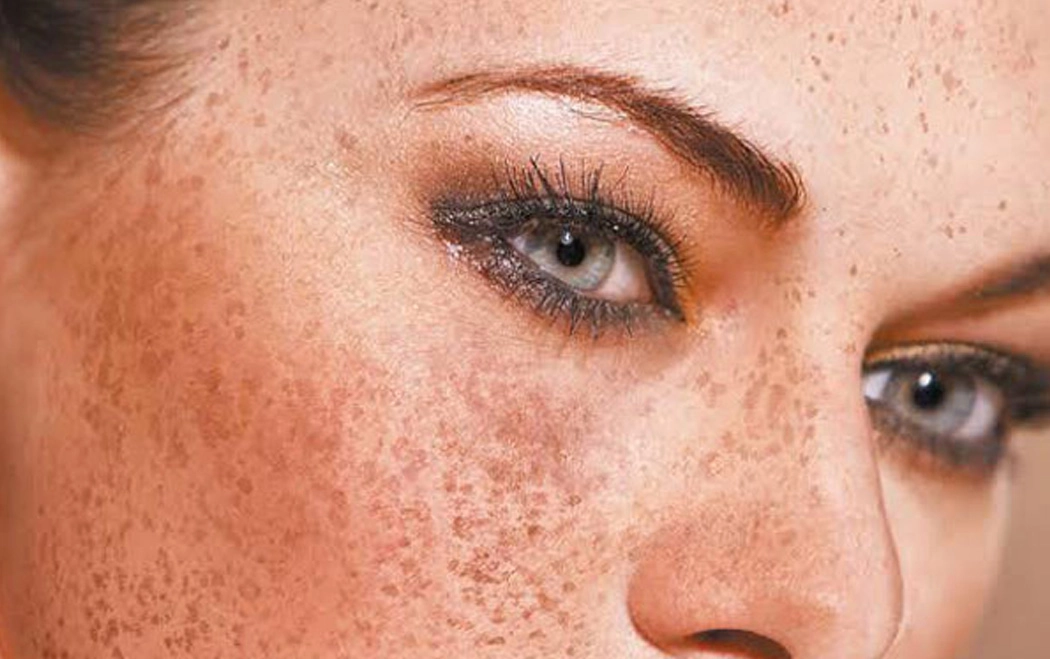 5 Ways to Better Cope With Melasma